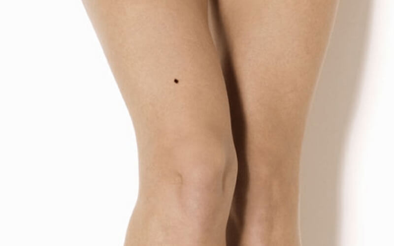 Nốt ruồi ở lòng bàn chân trái và phải có ý nghĩa gì?