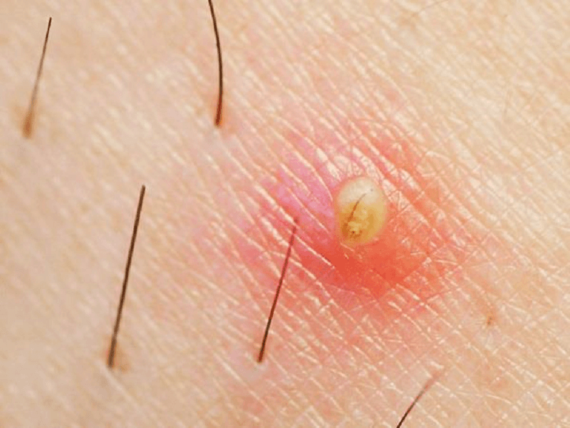 Viêm nang lông – Nguyên nhân và cách điều trị hiệu quả