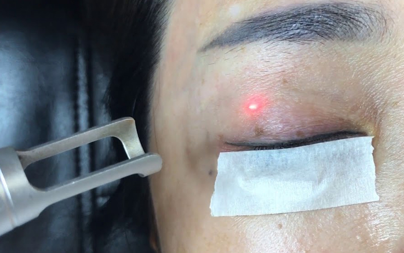 Sử dụng công nghệ phun mí cũ, lạc hậu dẫn đến phun mí mắt bị đau
