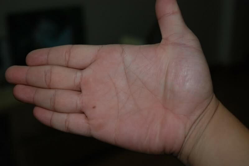 Nốt ruồi trong lòng bàn tay trái ở gò mộc tinh