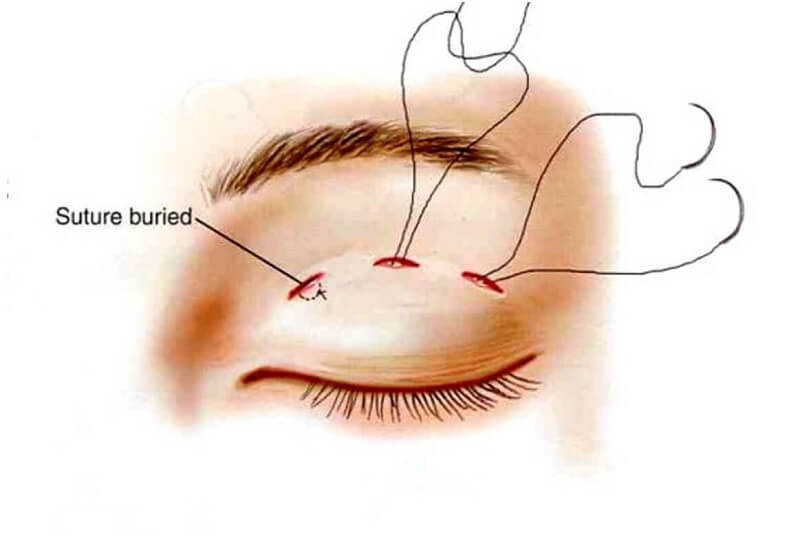 Cắt mí mắt bị trợn – Nguyên nhân và cách khắc phục hiệu quả