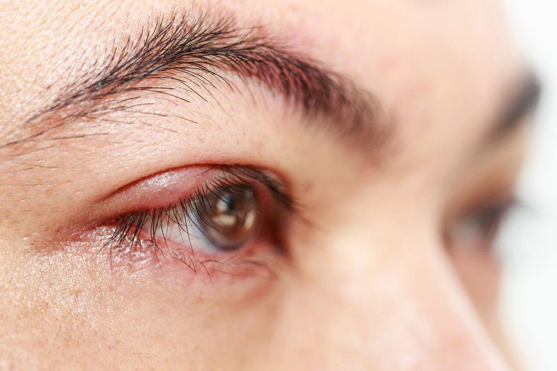 5 tác hại của mở rộng góc mắt – Có thể khắc phục không?