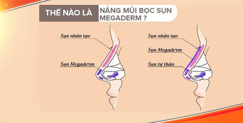 nang-mui-boc-sun-megaderm-1