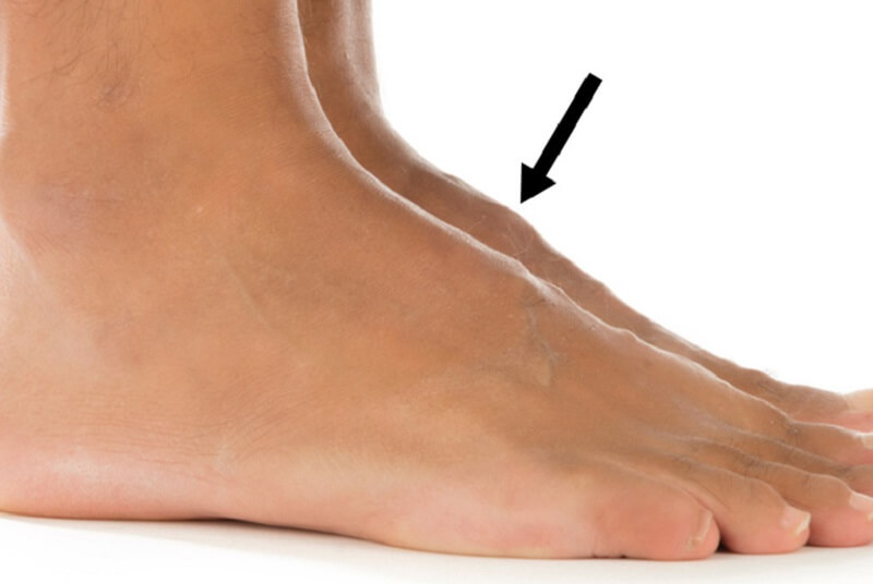 Nám da ở chân – Nguyên nhân và cách khắc phục hiệu quả