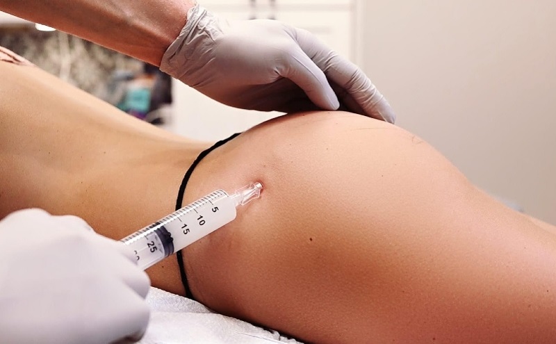 Tiêm filler mông là một phương pháp làm đẹp cho vòng 3 mà không cần phẫu thuật