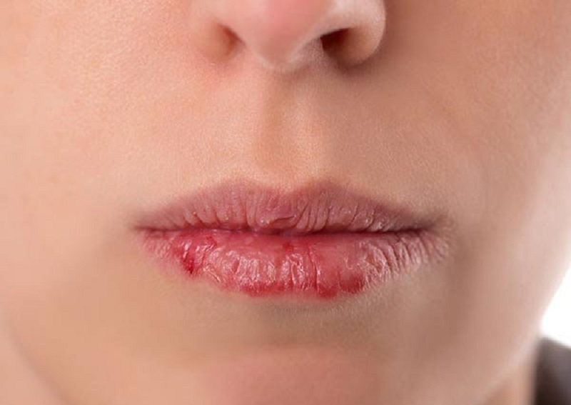 Các triệu chứng của nứt môi đó là bong vẩy, chảy máu
