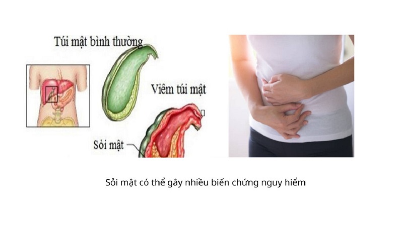 Rối loạn mật 