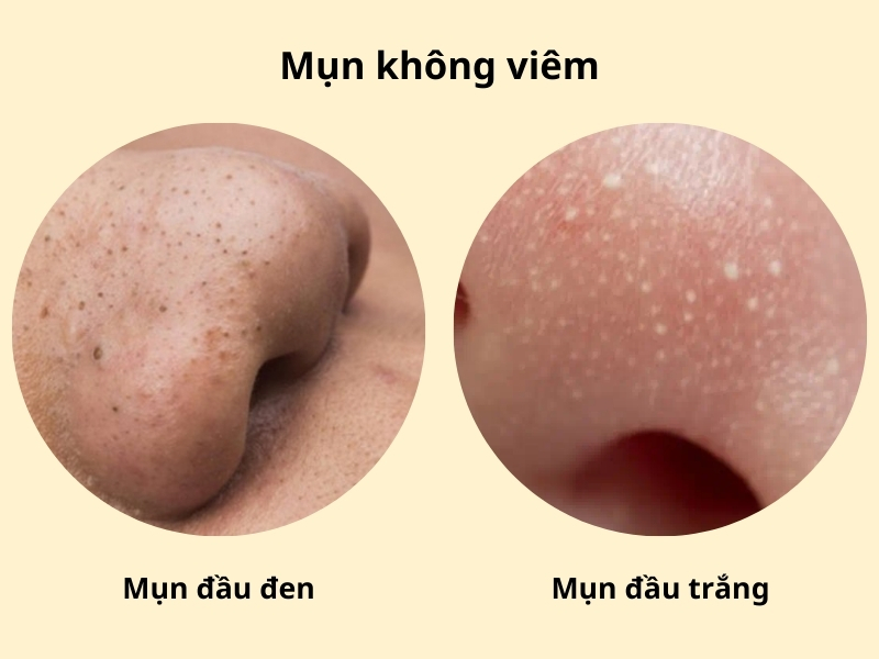 Mụn không viêm