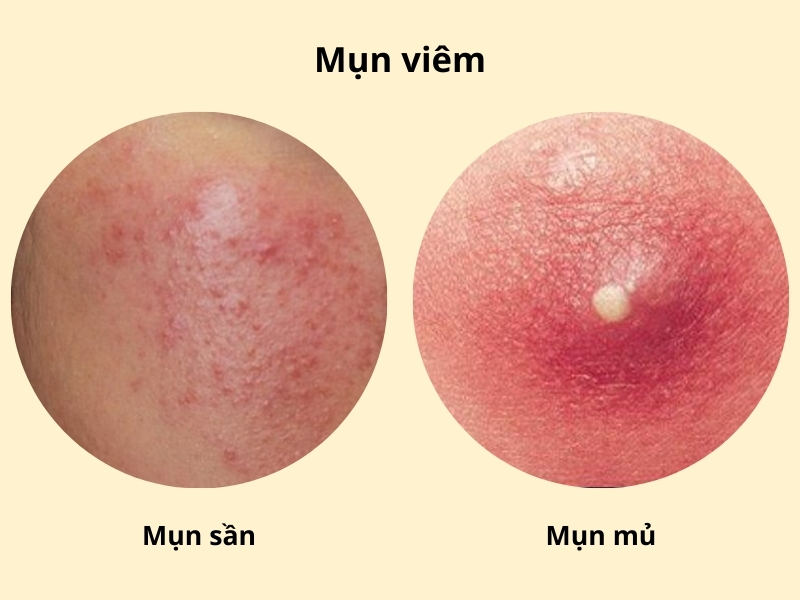 Mụn viêm