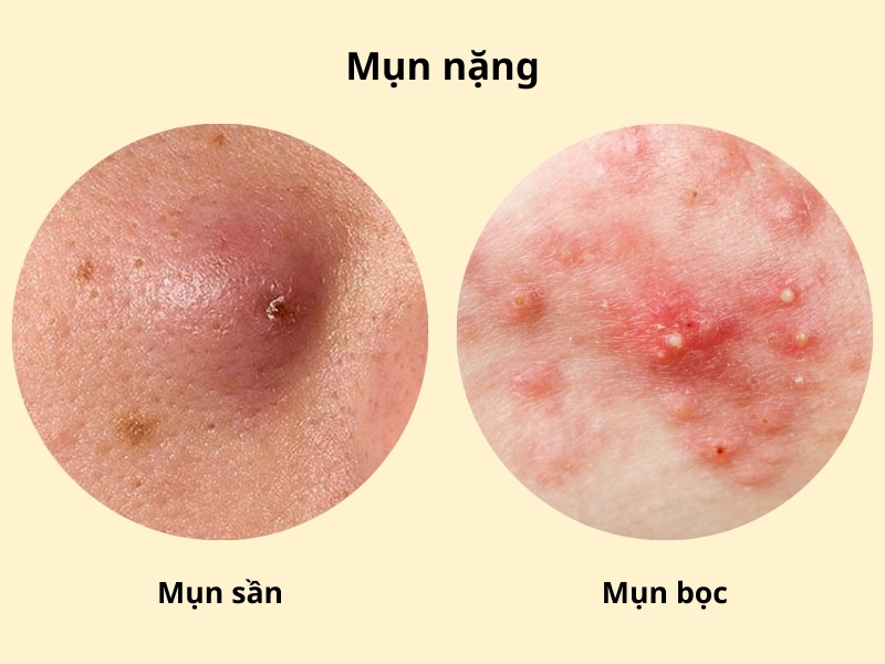 Mụn nặng