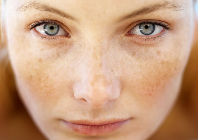 Nám là tình trạng những mảng màu nâu, đen xuất hiện trên da do sự gia tăng quá mức của các sắc tố melanin.
