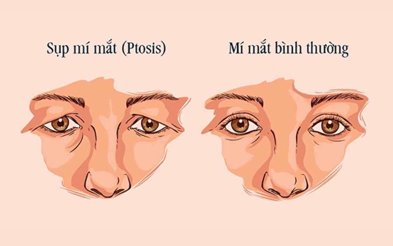 Mắt thường và bị sụp mí khác nhau thế nào?