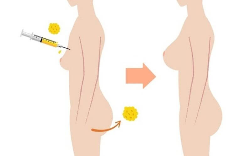 Nâng ngực bằng phương pháp cấy mỡ 