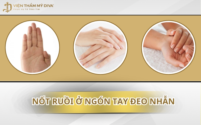 Nốt Ruồi Ở Ngón Tay Đeo Nhẫn: Báo Hiệu Tình Duyên Hay Sự Nghiệp Thăng Hoa?