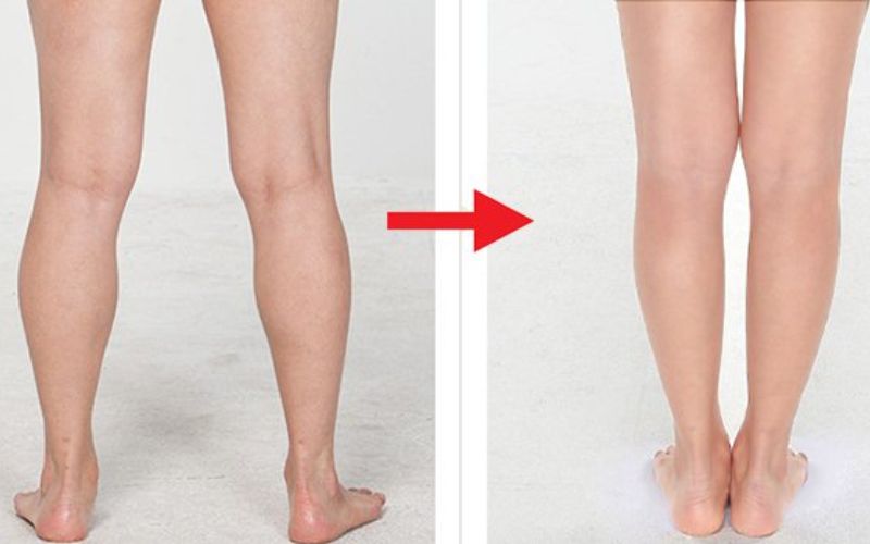 Phương pháp tiêm thon gọn bắp chân là gì?