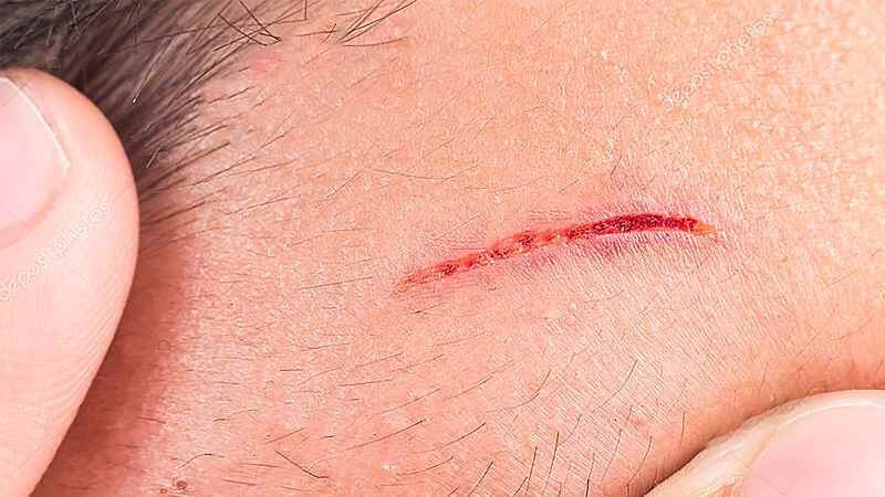 Những rủi ro có thể gặp khi cạo lông mặt