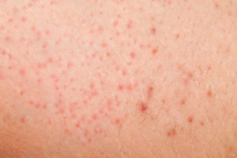 Khi tẩy sạch lông vùng kín, da tại đây có thể bị kích ứng dẫn đến đau đớn, ngứa ngáy hoặc viêm nhiễm