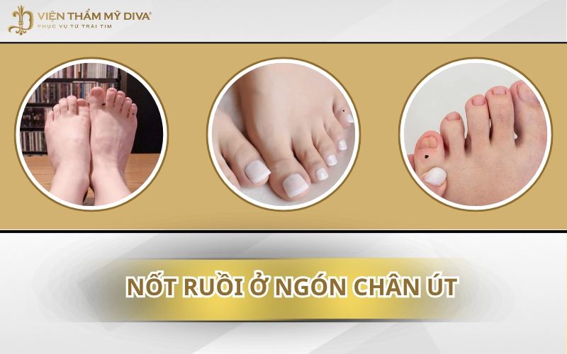 Vị Trí Nốt Ruồi Ngón Chân Út - Bật Mí Ý Nghĩa Phong Thủy Ít Ai Biết