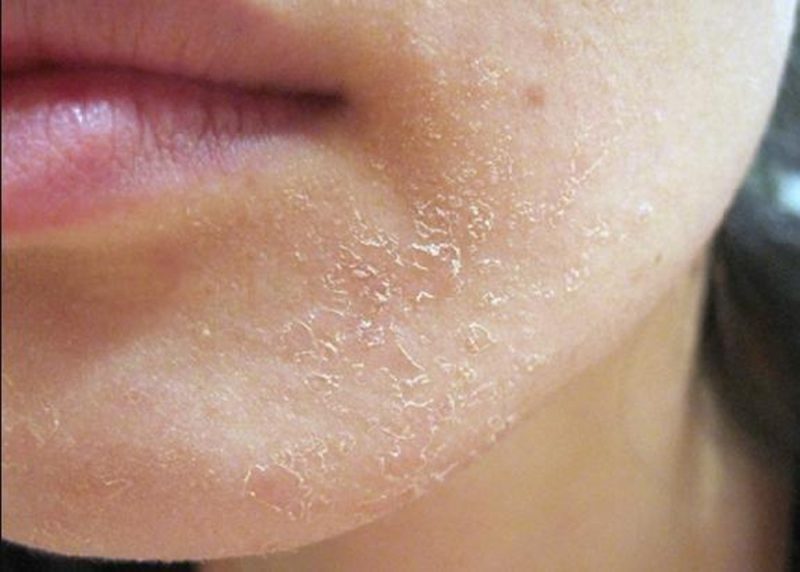 Dấu hiệu nhận biết da mặt bị ngứa và sần sùi là gì?