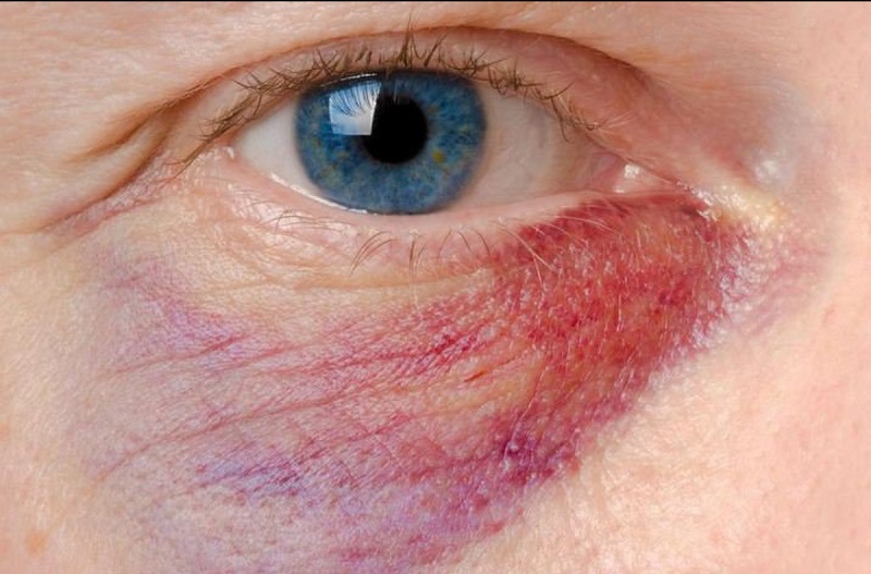 10+ cách làm tan máu bầm ở mắt tại nhà nhanh