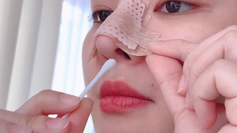 Cách vệ sinh mũi sau khi phẫu thuật nâng mũi