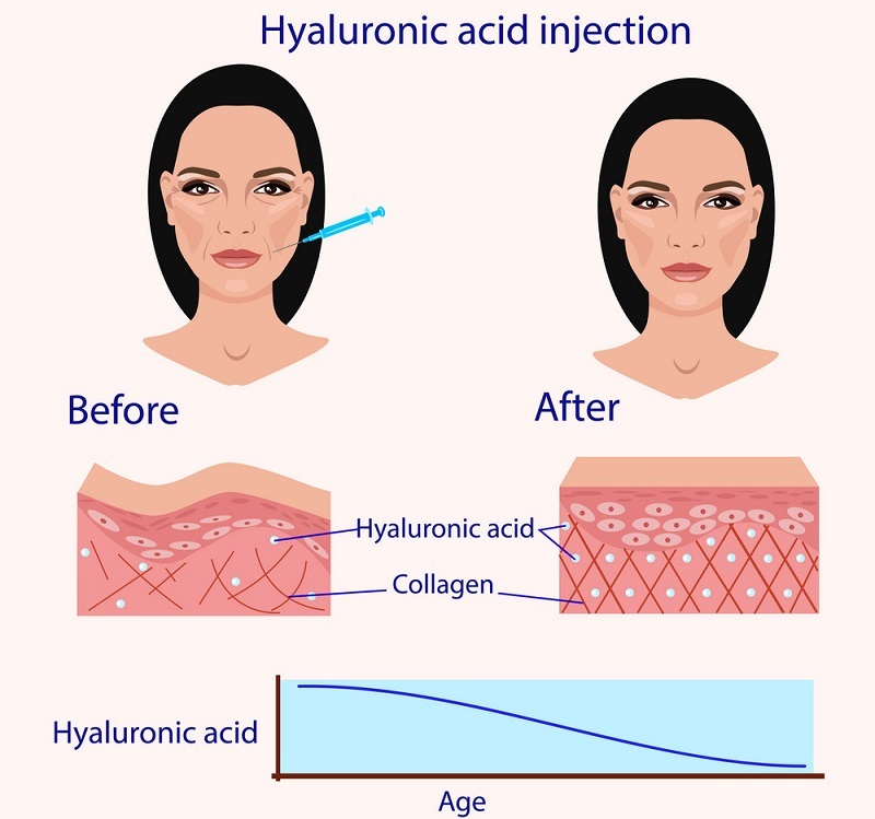 công dụng Hyaluronic acid 
