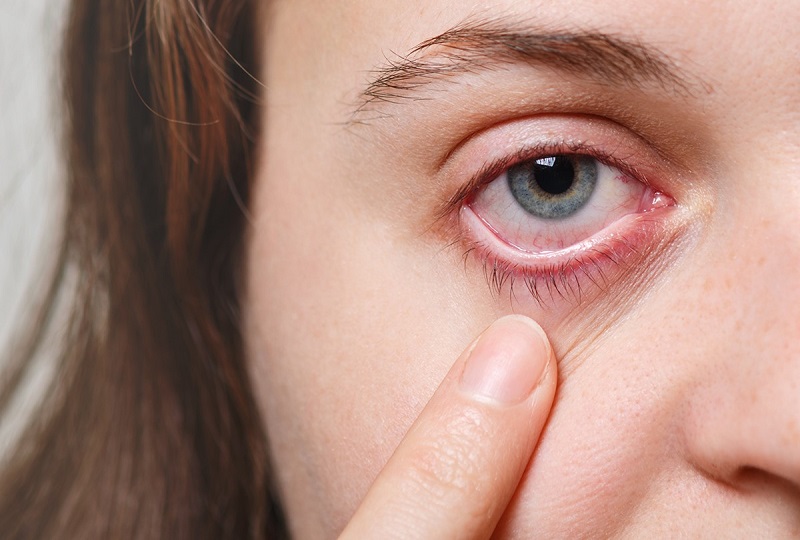 Mí mắt bị sưng sau khi ngủ dậy có ảnh hưởng xấu gì đến sức khỏe không?