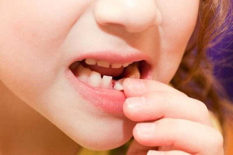 Nhổ răng trẻ em 