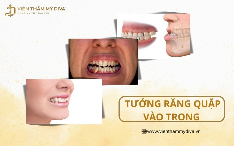 Tướng răng quặp vào trong là gì? Hậu quả và cách khắc phục