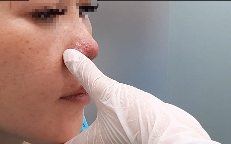 Một số triệu chứng cho thấy tiêm filler mũi lỗi