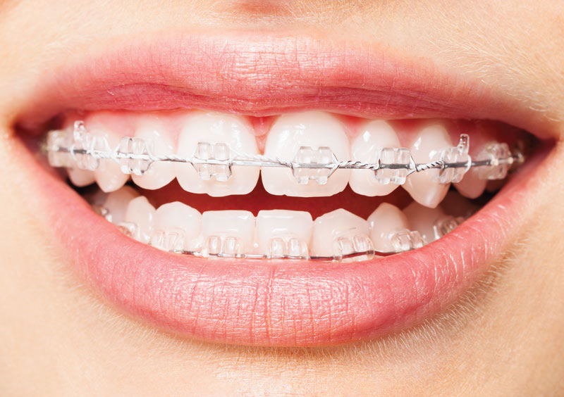Niềng răng thẩm mỹ giúp bạn sở hữu hàm răng ngô đều đẹp