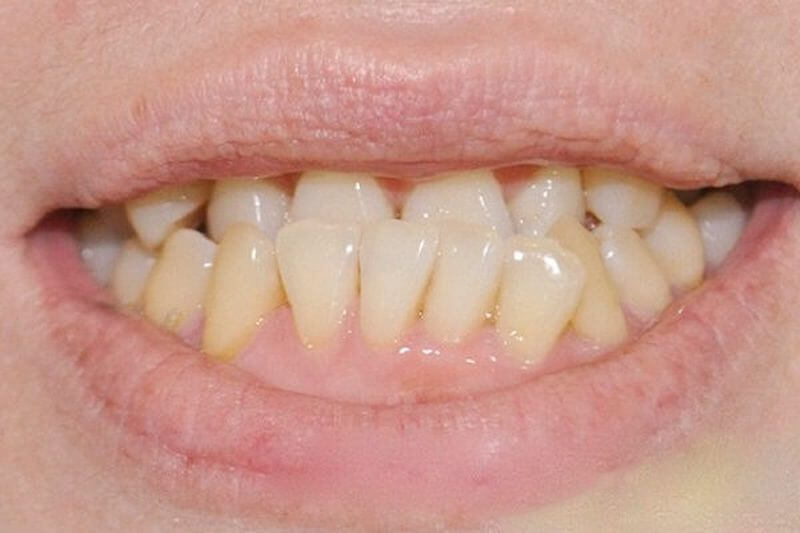 Tướng răng của phụ nữ có hàm răng mọc lộn xộn