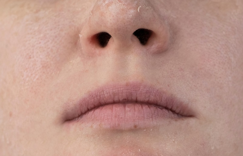 Bong tróc da ở vùng cánh mũi là gì? Khắc phục ra sao?
