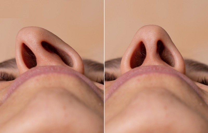 Cánh mũi bị lệch | Nguyên nhân và cách khắc phục