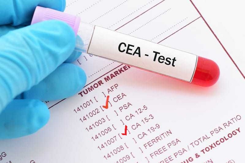 Chỉ số CEA là gì? Có ý nghĩa gì trong chuẩn đoán ung thư?