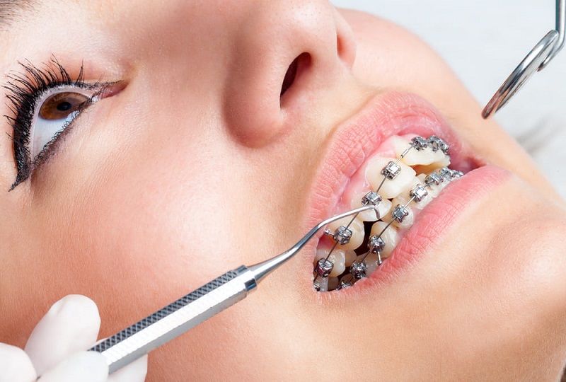 Đánh lún răng là kỹ thuật sử dụng trong niềng răng