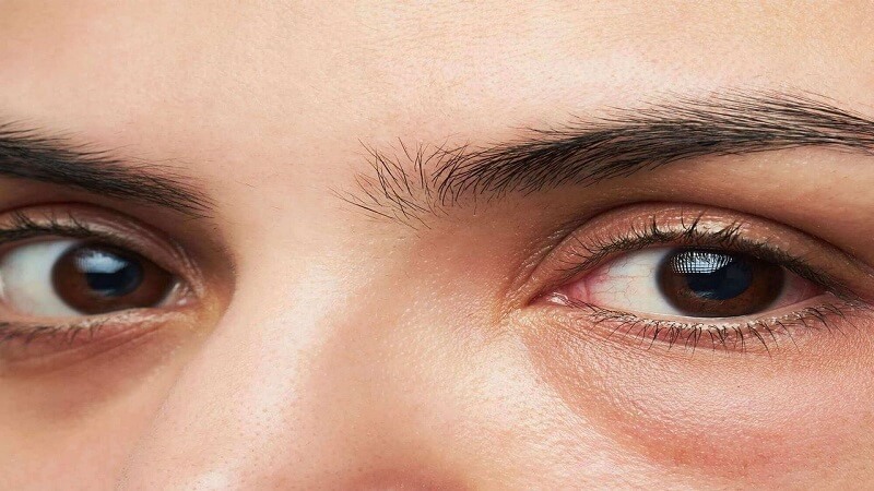 Bọng mắt là hiện tượng sưng nhẹ hay phồng lên ở phần bầu dưới mắt1