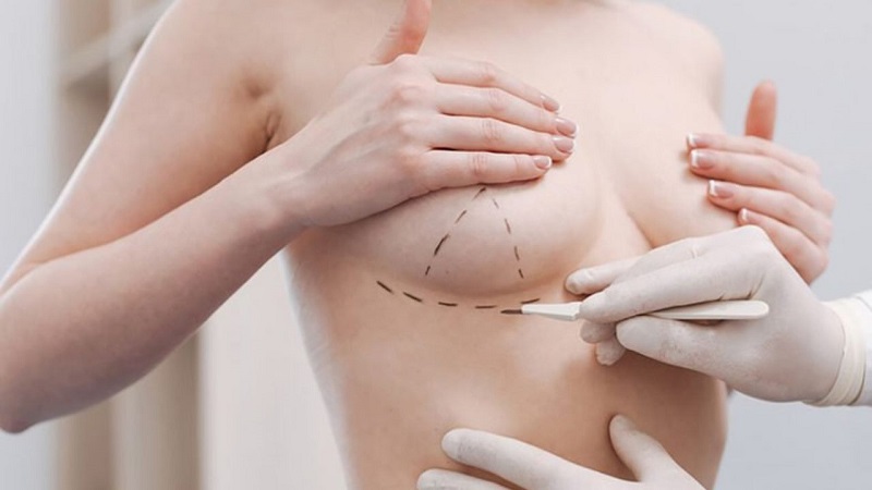 Một số biểu hiện bình thường sau khi nâng ngực sa trễ