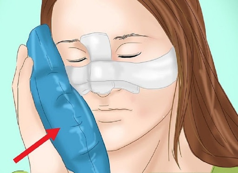 Cách chăm sóc mũi sau khi phẫu thuật