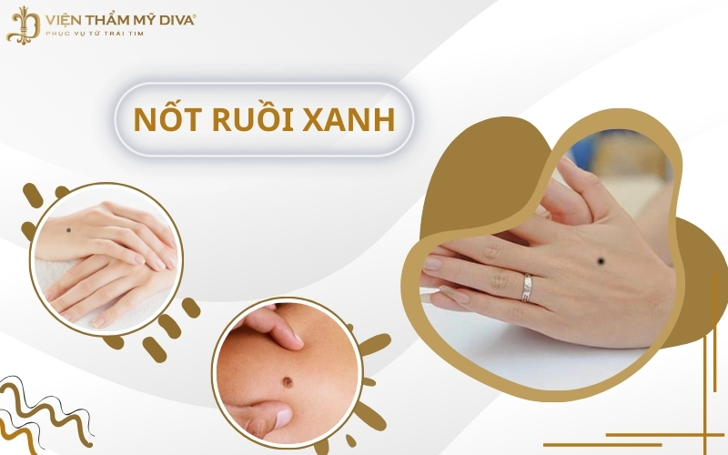 Nốt Ruồi Xanh Có Ý Nghĩa Gì? Tướng Số Tốt Hay Xấu?