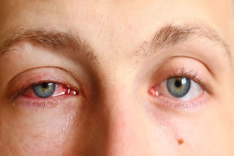 Triệu chứng thường gặp sau 1 đến 3 ngày cắt mí mắt nam 