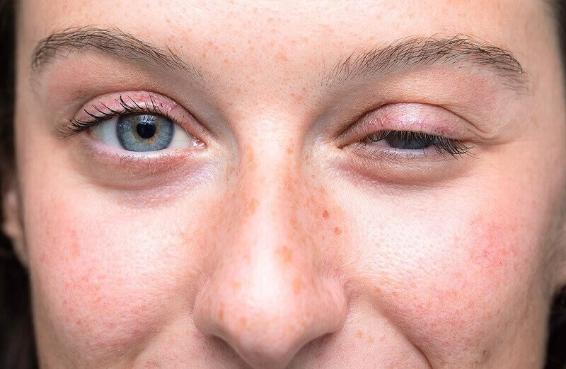 Sụp mí mắt nhược cơ là gì? Nguyên nhân và cách điều trị