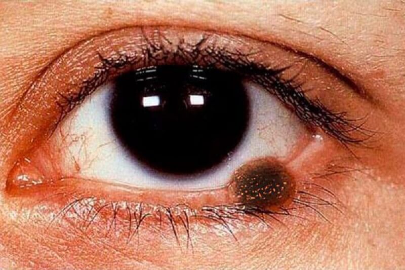 U mí mắt là gì? Những loại u mắt và cách điều trị hiệu quả