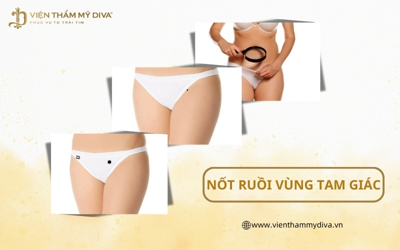 Nốt Ruồi Ở Vùng Tam Giác: Sự Thật Về Số Mệnh Và Sự Nghiệp