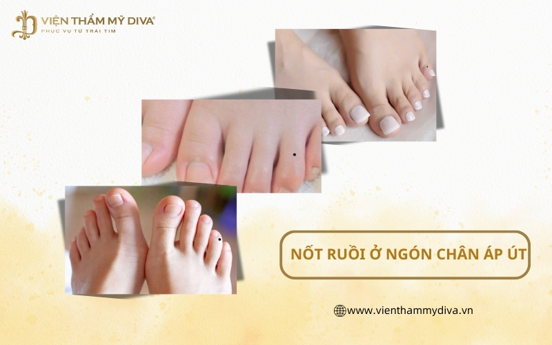 Nốt Ruồi Ở Ngón Chân Áp Út: Phân Tích Ý Nghĩa, May Mắn Và Vận Mệnh