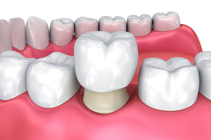 Bọc răng sứ giúp khắc phục các khuyết điểm về răng nhanh chóng