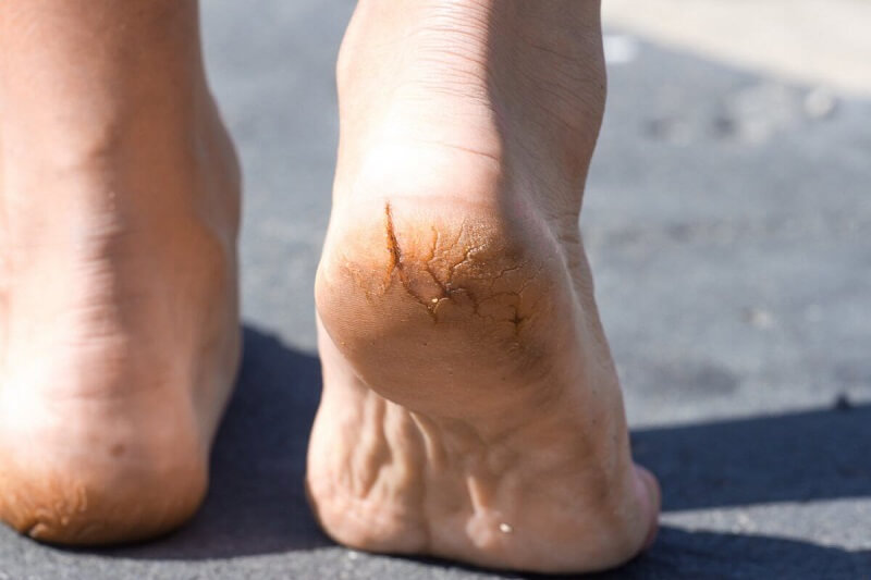 Một số nguyên nhân gây ra tình trạng nứt gót chân