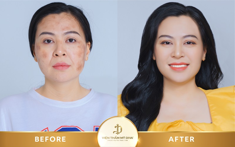 Hình ảnh khách hàng trước và sau khi tái tạo da tại Viện thẩm mỹ DIVA