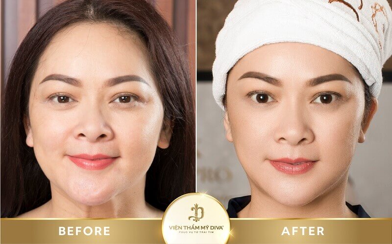 Địa chỉ tái tạo da ở Sóc Trăng uy tín, an toàn và hiệu quả 3