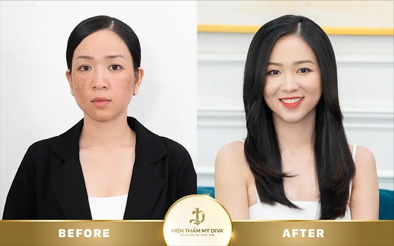 Hình ảnh khách hàng trước và sau khi trẻ hóa da tại Vĩnh Long ở Viện thẩm mỹ DIVA